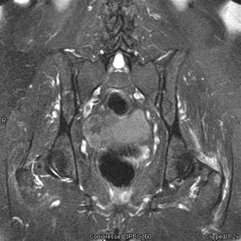 mri procedures and pathology: Trochanteric Bursitis