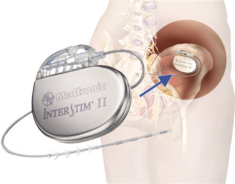 Sacral Neuromodulation (Interstim® Therapy) | Star Clinic