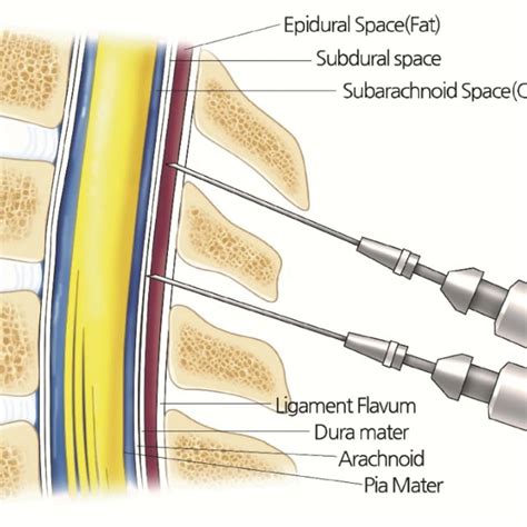 Anatomy of Epidural-Subdural-Subarachnoid space (from outside to inside ...