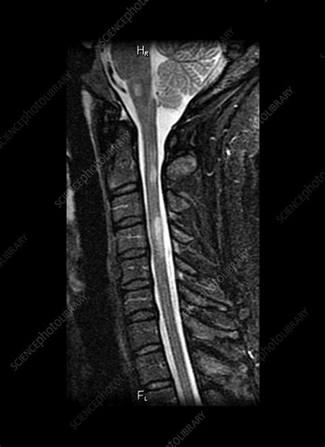 Multiple Sclerosis in Spinal Cord - Stock Image - C003/4639 - Science ...