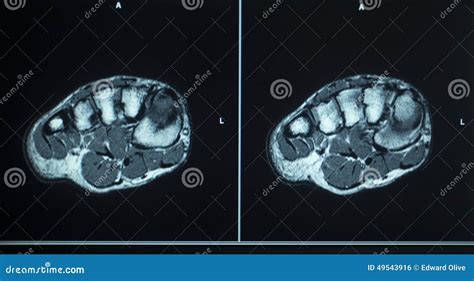 MRI Scan Test Results Foot Toes Injury Stock Photo - Image of healthcare, human: 49543916