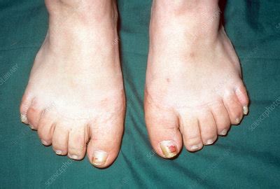 Polydactyly - Stock Image - C014/4328 - Science Photo Library