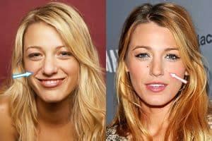 Did Blake Lively Have Plastic Surgery? (Before & After 2022)