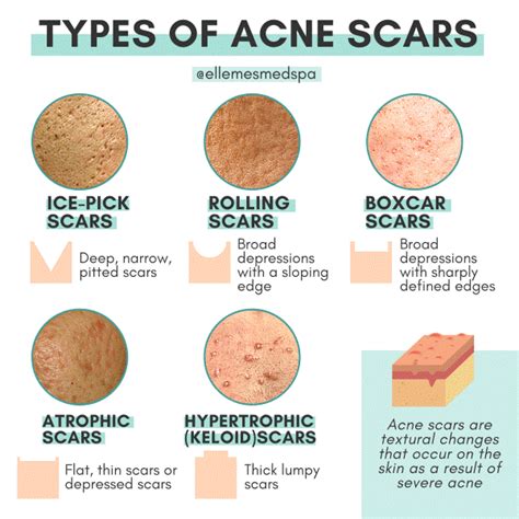 Different Types Of Acne Scars