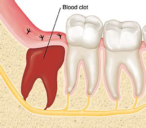 Wisdom Teeth Surgery- Your Recovery | Saint Luke's Health System