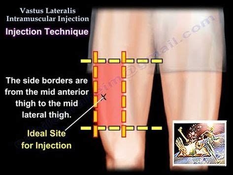 Vastus Lateralis Intramuscular Injection - Everything You Need To Know -... | Intramuscular ...