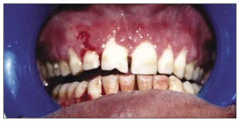 A 33-year-old male farmer with progressive gingival swelling and bleeding | Annals of Saudi Medicine