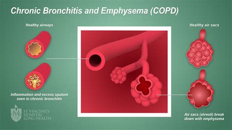 copd