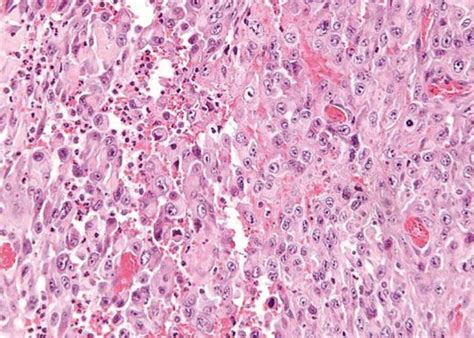 Soft Tissue Sarcoma - Pathology - Orthobullets