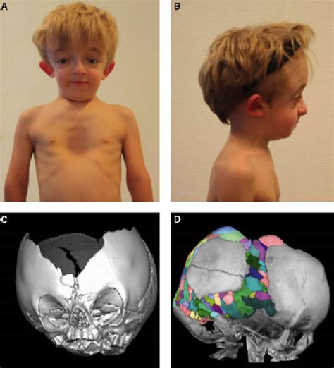 Carpenter syndrome causes, symptoms, diagnosis, treatment & life expectancy