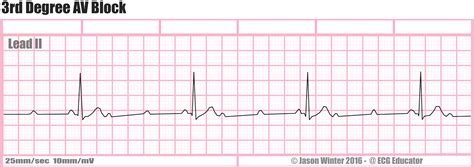 ECG Educator Blog : Heart Blocks