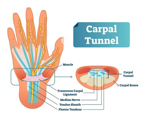 Carpal tunnel syndrome - hetyplant