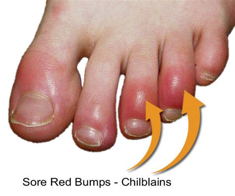 Chilblains on Feet Toes | FIR Socks for Toe Chilblains | TherapySocks.com