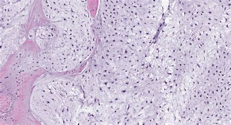 Chondrosarcoma - MyPathologyReport.ca