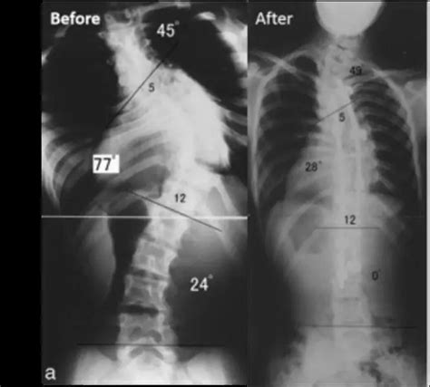 Larsen syndrome: causes, symptoms, treatment | Diseases and conditions 2024