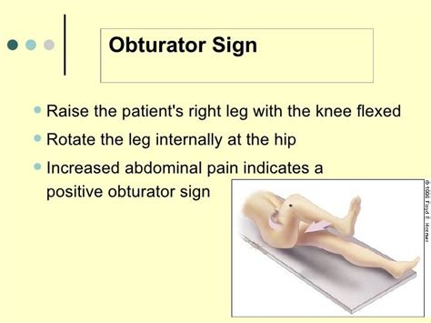 Psoas Sign And Obturator Sign