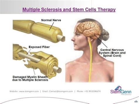 Multiple Sclerosis and Stem Cells Therapy