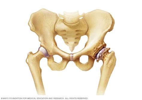 Pengapuran Sendi Panggul (Osteoarthritis Hip)