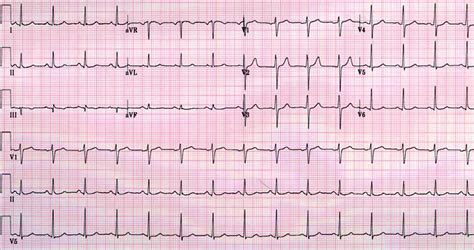 Normal 12-lead ECG