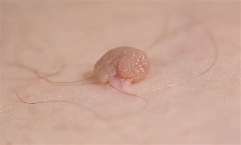 Pedunculated Skin Tag Or Acrochondon Or Soft Fibroma Papilloma Bump On Male Body Macro Shot ...