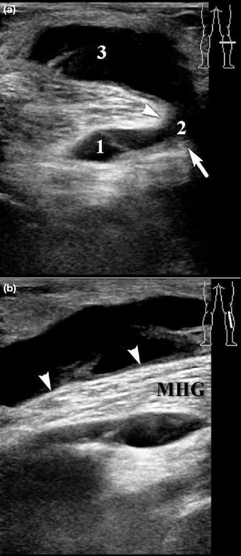 Figure 3 from Sonography of Baker’s Cyst (Popliteal Cyst): the Typical and Atypical Features ...