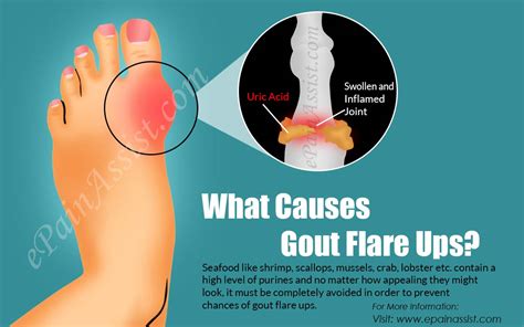 Foods That Trigger Gout Flare Up - GoutInfoClub.com