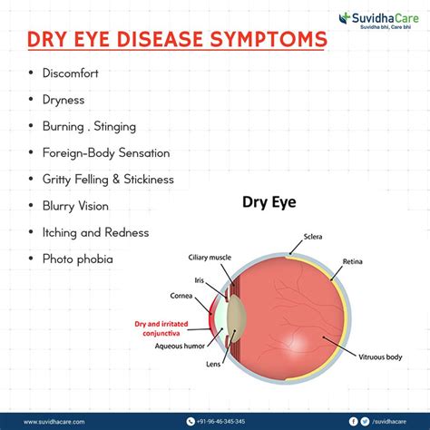 Signs and Symptoms of Dry Eye Disease #Health #Eyecare #DryEyeTreatment | Dry eye symptoms, Dry ...