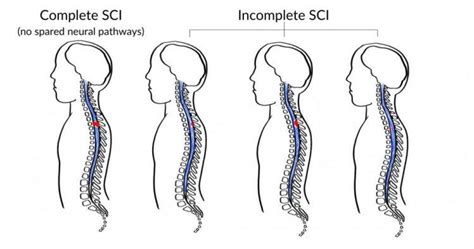 C3 Spinal Cord Injury: What to Expect and How to Recover