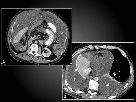 mesothelioma hereditary #Mesothelioma | Mesothelioma, Pleural effusion, Ct scan