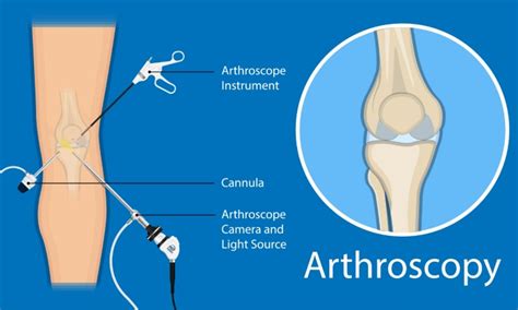 Arthroscopy: Purpose & Procedure – Welcome to SYS Medtech International ...