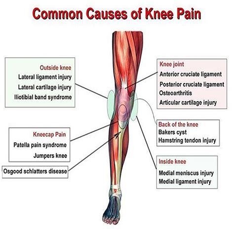 Common causes of knee pain #Kneepain #Knee #MDUB #Mdubmedical #Kneepaincauses #Medical #Fitness ...