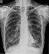 Chronic obstructive pulmonary disease | Radiology Reference Article | Radiopaedia.org