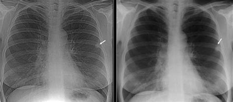 Calcified granuloma definition, causes, symptoms, diagnosis & treatment