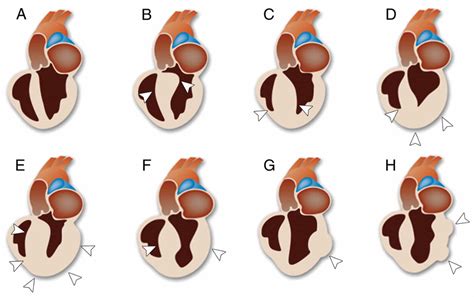 Asymmetric septal hypertrophy, definition, causes, symptoms, diagnosis, treatment & prognosis