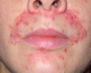 Perioral Dermatitis - Children, Treatment, Symptoms, Causes, and Diet