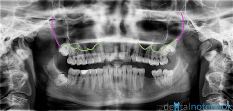 Floor Of Nasal Cavity Radiograph | Viewfloor.co