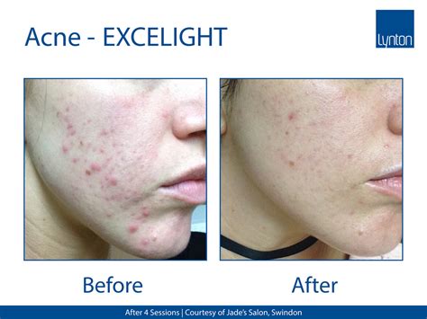 Acne Treatment | JH Skincare Clinic | IPL Laser and Dermalux LED for ...