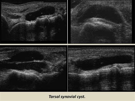 Presentation1.pptx. ultrasound examination of the ankle joint.