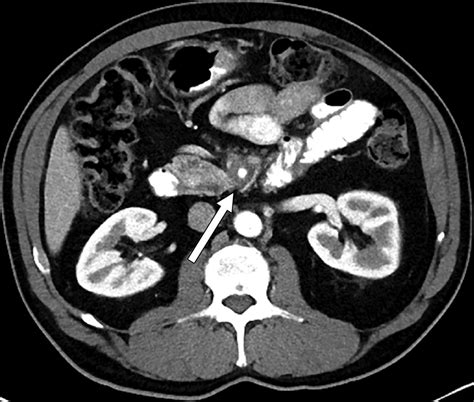 Advances in Pancreatic CT Imaging | AJR