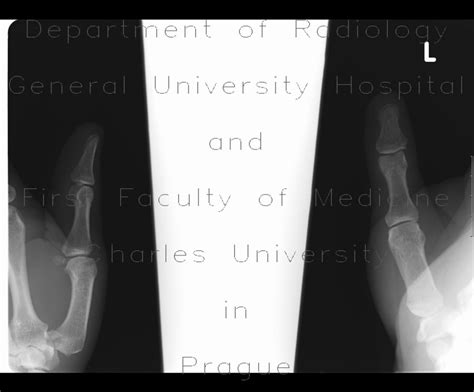 Radiology case: Bennett's fracture