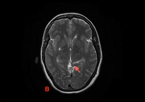 Left parahippocampal gyrus herniation | Eurorad