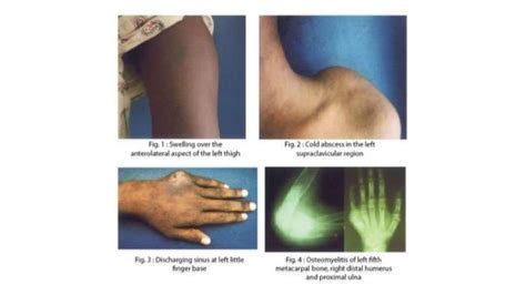 Skeletal Tuberculosis