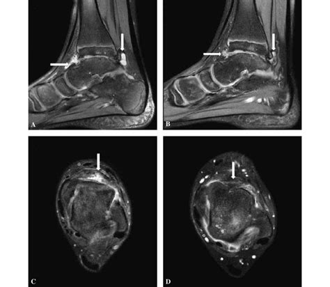 MRI of the left ankle joint. Side view : Tumefied synovium and free... | Download Scientific Diagram