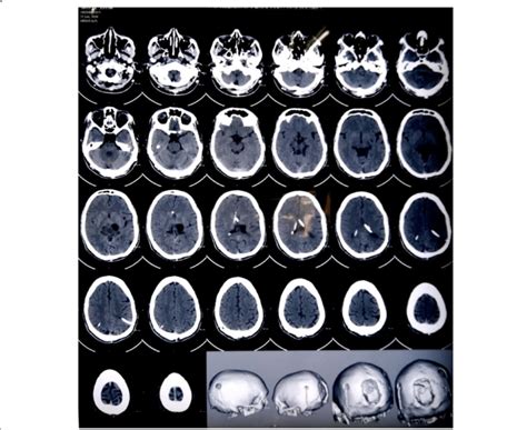 MRI brain showing presence of ventricular ends of right VP shunt... | Download Scientific Diagram