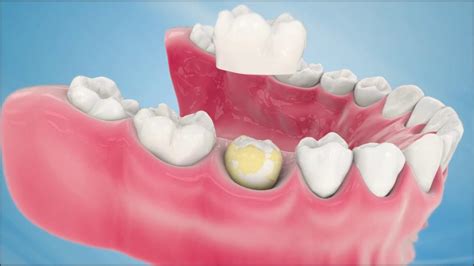 Dental Crown Procedure - YouTube