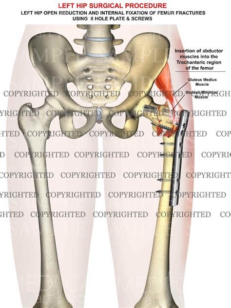 Left femur intertrochanteric fracture - ORIF – Medical Art Works