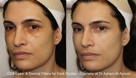 CO2 Laser Skin Resurfacing London, Before & After Pics (UK’s Best Clinic)