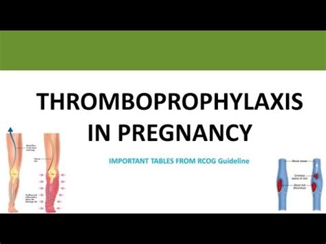 Thromboprophylaxis in Pregnancy (Important Tables Only), RCOG Guideline ...