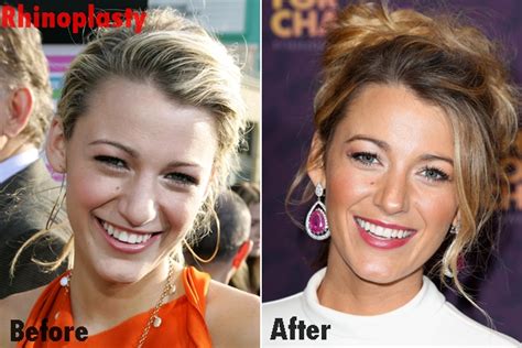 Blake Lively Nose Job Plastic Surgery Before Aafter Photos