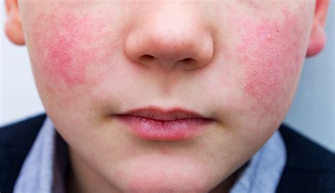 Viral Exanthem Rashes In Children - Dr. Green Mom